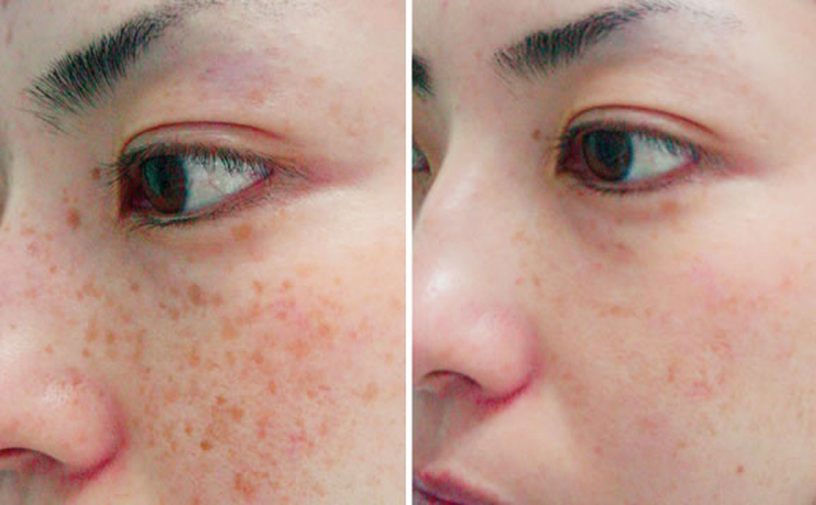 laser for freckles & pigmentation
